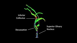 An Approach to Diffusion Tensor Imaging of Auditory Brainstem Implant Candidates [upl. by Yffat]