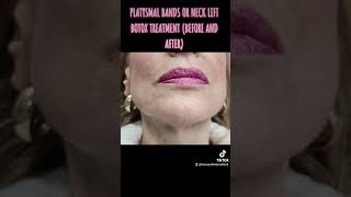 PLATYSMAL BANDS OR NECK LIFT BOTOX TREATMENT BEFORE AND AFTER [upl. by Hanej463]