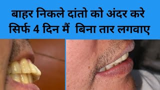 बाहर निकले दांतों का इलाज सिर्फ 4 दिन में बिना तार लगवाए Smile designSmile makeoverदाँतteeth [upl. by Refinney]