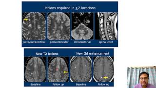 Imaging in Demyelinating disorders of CNS [upl. by Ecnahoy]