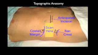 Ultrasound Guided Transversus Abdominis Plane Block [upl. by Budge]