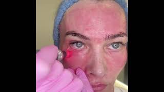 Microneedling Technique  Under Eye [upl. by Randall]