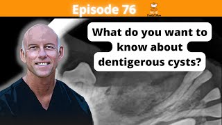 Ep 76  What do you want to know about dentigerous cysts [upl. by Linzer]