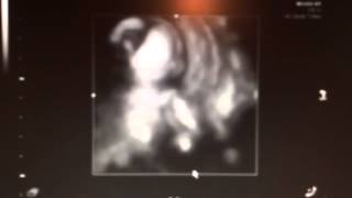 15 week ultrasound with Braxton hicks [upl. by Kamilah]