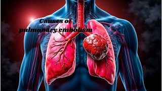 What causes pulmonary embolism Understanding the risks [upl. by Holder]