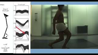 Gait Analysis Patterns in Diplegic Cerebral Palsy [upl. by Enisamoht]