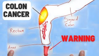 4 Warning Signs of Colon Cancer You Should NEVER Ignore [upl. by Eidurt558]