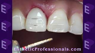 Porcelain Veneers Preparation Techniques 1 [upl. by Mainis]