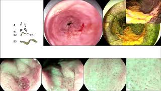 ESD for esophageal Squamous Carcinoma in a Patient with Achalasia [upl. by Amaj]