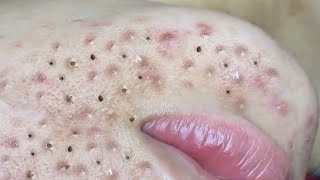 Treatment Of Blackheads And Hidden Acne 048 [upl. by Savvas]