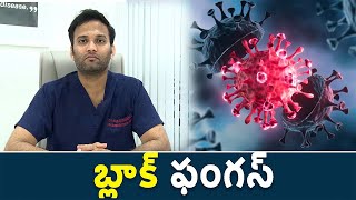 Mucormycosis Treatment  బ్లాక్ ఫంగస్ [upl. by Vijar766]