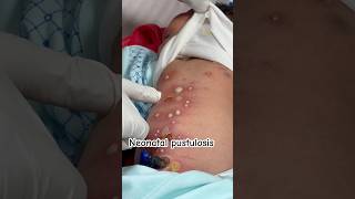 Neonatal pustulosis newborn day 5 skin infection ankur maitrika hospital jammu [upl. by Giulio855]