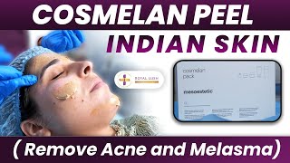 Cosmelan Peel Procedure in India  Cosmelan Peel Treatment Before and After for Melasma Dark Skin [upl. by Aniretac]