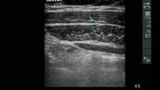 Ultrasound view of the abdominal wall [upl. by Eniarol]