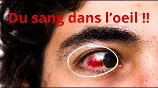 Yeux rouges et taches de sang  Causes et traitements expliqués [upl. by Eikcuhc]