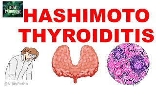 Hashimoto Thyroiditis Etiopathogenesis Gross m Microscopy and Clinical Features [upl. by Sommers]