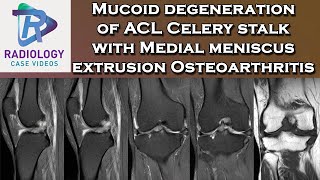 Mucoid degeneration of ACL Celery stalk with Medial meniscus extrusion Osteoarthritis [upl. by Aley]