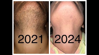 147 hours Electrolysis Hair Removal  Permanent Facial Hair Removal Expectations  PCOS Hirsutism [upl. by Ahtar]