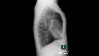 enfisema polmonare  sintomicause e cure [upl. by Eissed335]