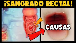 ¡CUIDADO ¿SANGRADO RECTAL ¿CUÁLES SON LAS CAUSAS ¿ES SINÓNIMO DE CÁNCER [upl. by Grata]