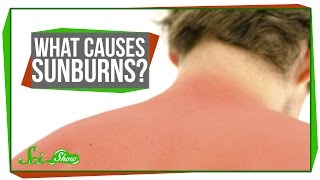 What Causes Sunburns [upl. by Eninahpets884]