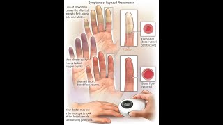 Understanding Raynaud’s Phenomenon  YOU MUST KNOW  DONT FORGET TO SUBSCRIBE THIS CHANNEL [upl. by Eleon]