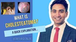 What is Cholesteatoma  an ear surgeon explains [upl. by Flannery270]