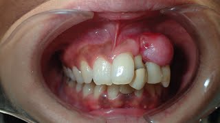 Massive Epulis Removing TreatmentDental videos showing oral Surgery teeth youtubeshortsoperation [upl. by Nennek]