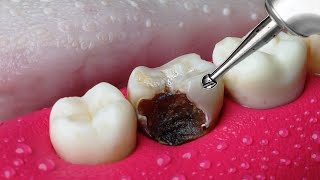 ASMR Restoration Incredible Tooth Cavity And The Master Dentist [upl. by Yehudit669]