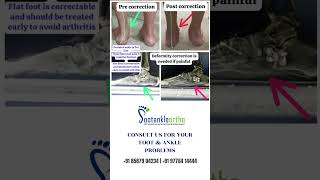 FOOT DEFORMATION CORRECTION footproblem deformationoffoot footandanklesurgeon footcondition [upl. by Ikim]