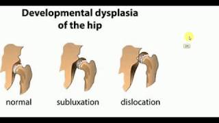 ORTHOPEDICS LECTURES  Hip  DEVELOPMENTAL DYSPLASIA OF HIP  DDH [upl. by Yanat425]