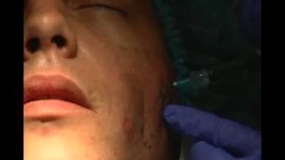 Aumento de pómulos mejillas y recuperación del contorno facial  Tratamiento Facial [upl. by Ellek151]