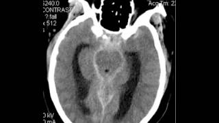 CT Head Subarachnoid Hemorrhage DISCUSSION by Radiologist [upl. by Elephus324]