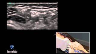 How To Ultrasound Guided Popliteal Sciatic Nerve Block 3D Video [upl. by Airdua]