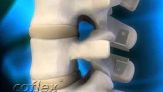 coflex motion spine [upl. by Aniles961]