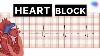 Heart Block  AV Block  ECG  EKG  OSCE Guide  UKMLA  CPSA [upl. by Ahkeber366]