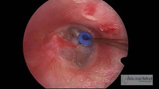 Timpanotomia para Tubo de Ventilação [upl. by Ricca]