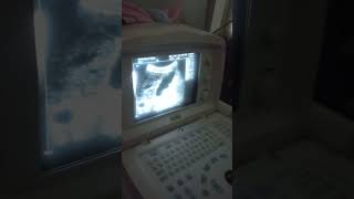 abdominal ultrasound cirrhotic liver cholecystitis with cholelithiasisshortvlog [upl. by Malamut83]