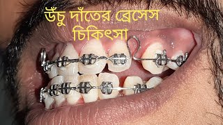 উঁচু দাঁতের চিকিৎসা চলছে। Dental braces treatment of proclined teeth [upl. by Mildrid975]