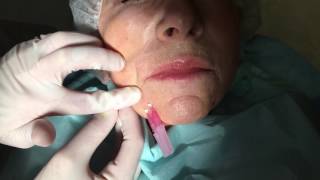 DrAvaliani performing Instant Thread Lift using NovaThreads [upl. by Thacher47]