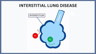 Interstitial Lung Disease Explained [upl. by Anella]