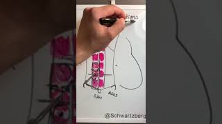 Ideal stoma placement handdrawn SchwartzbergMD [upl. by Aihtyc]