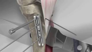 Tibial Tubercle Osteotomy [upl. by Dash]