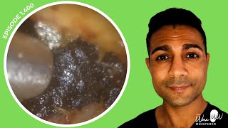 1400  Severe Ear Wax Blockage Removal  YOUR HELP MAY BE NEEDED ABOUT POOR UK EAR CARE [upl. by Noinatrad]