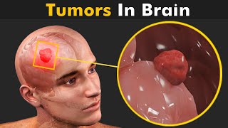 How Tumors Are Formed Inside The Brain  Glioma Brain Tumors 3D Animation [upl. by Aleras]