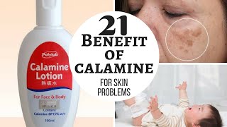 CALAMINE lotion  Lacto calamine lotion uses in detail side effects [upl. by Dmitri]