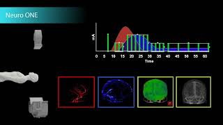 Complete Brain Perfusion Imaging in Just One Minute [upl. by Anevad]