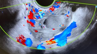 Ultrasound of acute salpingitis thick vascular fallop tube endometriotic simple amp nabothian cyst [upl. by Bashemath234]