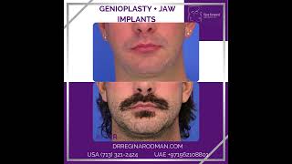 Genioplasty  Jaw Implants [upl. by Tammi]