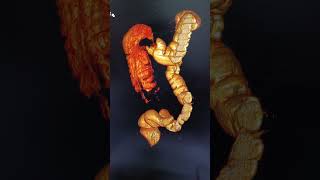 CT colonography 3D RECONSTRUCTION IMAGE paramedical [upl. by Avlis]